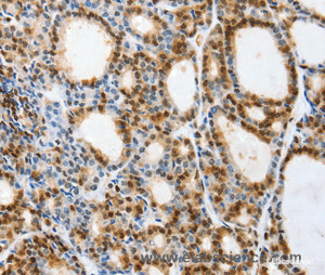 Immunohistochemistry of paraffin-embedded Human thyroid cancer tissue using SELENOS Polyclonal Antibody at dilution 1:40
