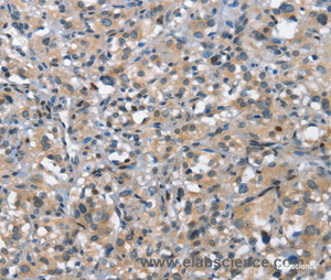 Immunohistochemistry of paraffin-embedded Human thyroid cancer tissue using DDR2 Polyclonal Antibody at dilution 1:40