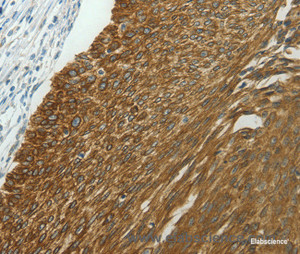 Immunohistochemistry of paraffin-embedded Human cervical cancer tissue using NDRG2 Polyclonal Antibody at dilution 1:40