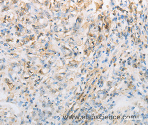 Immunohistochemistry of paraffin-embedded Human gasrtic cancer tissue using NPPC Polyclonal Antibody at dilution 1:70