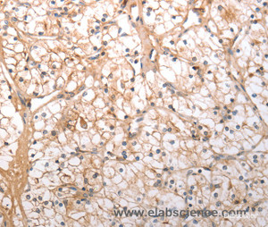 Immunohistochemistry of paraffin-embedded Human renal cancer tissue using HCRTR1 Polyclonal Antibody at dilution 1:100