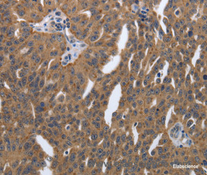 Immunohistochemistry of paraffin-embedded Human ovarian cancer tissue using PDGFA Polyclonal Antibody at dilution 1:40