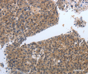 Immunohistochemistry of paraffin-embedded Human liver cancer tissue using PDGFB Polyclonal Antibody at dilution 1:40