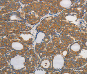 Immunohistochemistry of paraffin-embedded Human thyroid cancer tissue using PPP2CB Polyclonal Antibody at dilution 1:80