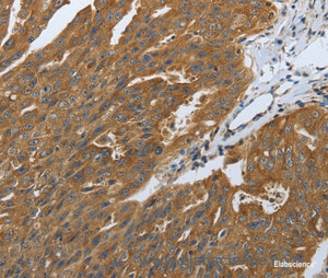 Immunohistochemistry of paraffin-embedded Human ovarian cancer tissue using DLG4 Polyclonal Antibody at dilution 1:40