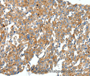 Immunohistochemistry of paraffin-embedded Human breast cancer tissue using CXCL12 Polyclonal Antibody at dilution 1:40