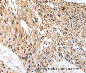 Immunohistochemistry of paraffin-embedded Human esophagus cancer tissue using SLC1A7 Polyclonal Antibody at dilution 1:60