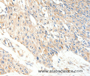 Immunohistochemistry of paraffin-embedded Human esophagus cancer tissue using SLC27A1 Polyclonal Antibody at dilution 1:40
