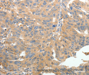 Immunohistochemistry of paraffin-embedded Human ovarian cancer tissue using TERT Polyclonal Antibody at dilution 1:50