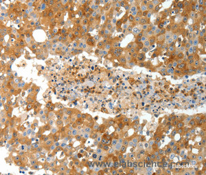 Immunohistochemistry of paraffin-embedded Human breast cancer tissue using TEP1 Polyclonal Antibody at dilution 1:40