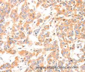 Immunohistochemistry of paraffin-embedded Human breast cancer tissue using Factor XIIIa Polyclonal Antibody at dilution 1:80