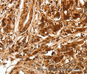 Immunohistochemistry of paraffin-embedded Human gasrtic cancer tissue using TGF β Receptor I Polyclonal Antibody at dilution 1:70