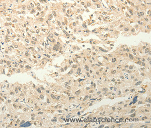 Immunohistochemistry of paraffin-embedded Human esophagus cancer tissue using FZD8 Polyclonal Antibody at dilution 1:50