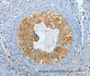 Immunohistochemistry of paraffin-embedded Human cervical cancer tissue using DGK zeta Polyclonal Antibody at dilution 1:60