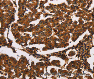 Immunohistochemistry of paraffin-embedded Human breast cancer tissue using ARSB Polyclonal Antibody at dilution 1:50
