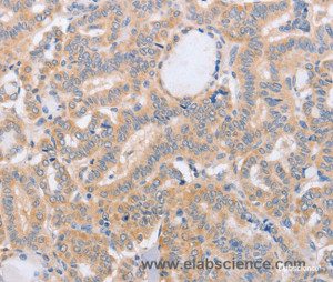Immunohistochemistry of paraffin-embedded Human thyroid cancer tissue using BST1 Polyclonal Antibody at dilution 1:40