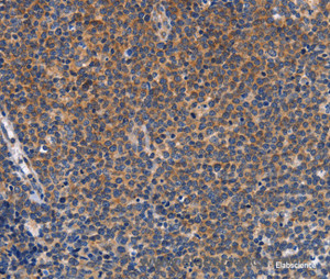 Immunohistochemistry of paraffin-embedded Human Lymphoma tissue using CCL23 Polyclonal Antibody at dilution 1:50