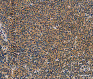 Immunohistochemistry of paraffin-embedded Human Lymphoma tissue using TNFRSF8 Polyclonal Antibody at dilution 1:50