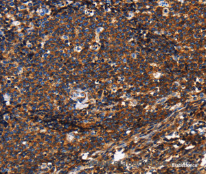 Immunohistochemistry of paraffin-embedded Human Lymphoma tissue using CD45 Polyclonal Antibody at dilution 1:60
