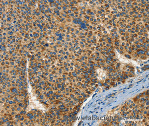 Immunohistochemistry of paraffin-embedded Human liver cancer tissue using IFT74 Polyclonal Antibody at dilution 1:60