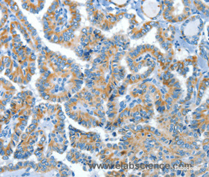 Immunohistochemistry of paraffin-embedded Human thyroid cancer tissue using COG1 Polyclonal Antibody at dilution 1:60