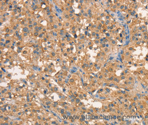 Immunohistochemistry of paraffin-embedded Human thyroid cancer tissue using CRELD1 Polyclonal Antibody at dilution 1:40