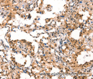 Immunohistochemistry of paraffin-embedded Human thyroid cancer tissue using CUL4B Polyclonal Antibody at dilution 1:50