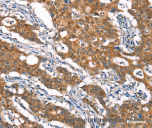 Immunohistochemistry of paraffin-embedded Human gasrtic cancer tissue using CYLD Polyclonal Antibody at dilution 1:35