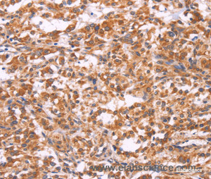 Immunohistochemistry of paraffin-embedded Human thyroid cancer tissue using EMP2 Polyclonal Antibody at dilution 1:30