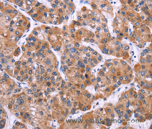 Immunohistochemistry of paraffin-embedded Human liver cancer tissue using MSMO1 Polyclonal Antibody at dilution 1:40