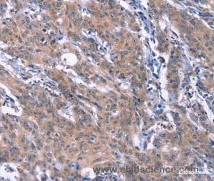 Immunohistochemistry of paraffin-embedded Human gasrtic cancer tissue using ESPL1 Polyclonal Antibody at dilution 1:40