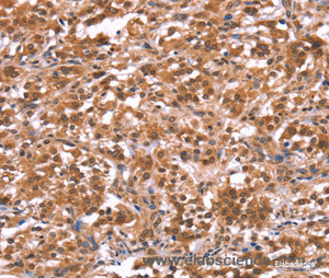 Immunohistochemistry of paraffin-embedded Human thyroid cancer tissue using AMER1 Polyclonal Antibody at dilution 1:40