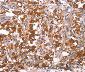 Immunohistochemistry of paraffin-embedded Human thyroid cancer tissue using GLMN Polyclonal Antibody at dilution 1:40