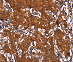 Immunohistochemistry of paraffin-embedded Human gasrtic cancer tissue using HCAR2 Polyclonal Antibody at dilution 1:40
