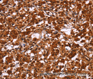 Immunohistochemistry of paraffin-embedded Human thyroid cancer tissue using HIPK1 Polyclonal Antibody at dilution 1:30