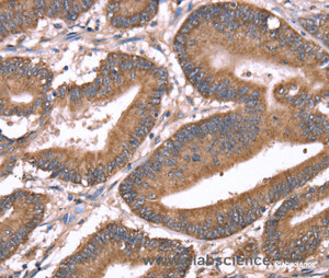 Immunohistochemistry of paraffin-embedded Human colon cancer tissue using HRG Polyclonal Antibody at dilution 1:50