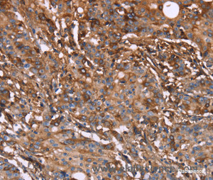 Immunohistochemistry of paraffin-embedded Human gasrtic cancer tissue using HP Polyclonal Antibody at dilution 1:40