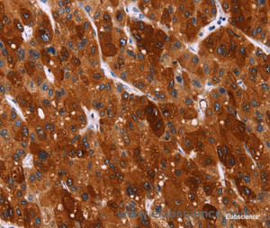 Immunohistochemistry of paraffin-embedded Human liver cancer tissue using HSPB6 Polyclonal Antibody at dilution 1:40