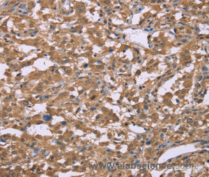 Immunohistochemistry of paraffin-embedded Human liver cancer tissue using IFNA2 Polyclonal Antibody at dilution 1:40