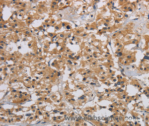 Immunohistochemistry of paraffin-embedded Human thyroid cancer tissue using INPPL1 Polyclonal Antibody at dilution 1:40