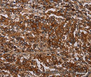 Immunohistochemistry of paraffin-embedded Human liver cancer tissue using MAGEC2 Polyclonal Antibody at dilution 1:40