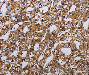 Immunohistochemistry of paraffin-embedded Human prostate cancer tissue using MEIS1 Polyclonal Antibody at dilution 1:40