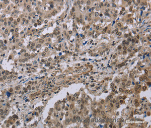 Immunohistochemistry of paraffin-embedded Human liver cancer tissue using MGLL Polyclonal Antibody at dilution 1:40