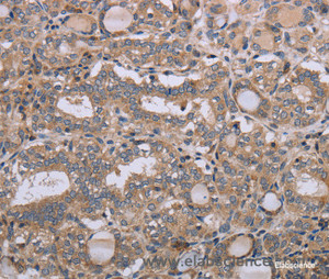 Immunohistochemistry of paraffin-embedded Human thyroid cancer tissue using NAA25 Polyclonal Antibody at dilution 1:40