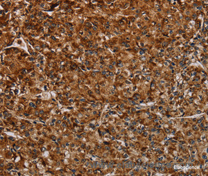 Immunohistochemistry of paraffin-embedded Human prostate cancer tissue using NDUFAB1 Polyclonal Antibody at dilution 1:40