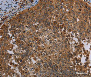 Immunohistochemistry of paraffin-embedded Human cervical cancer tissue using OSM Polyclonal Antibody at dilution 1:30