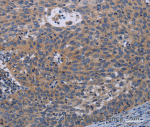 Immunohistochemistry of paraffin-embedded Human cervical cancer tissue using PAPPA Polyclonal Antibody at dilution of 1:50