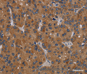 Immunohistochemistry of paraffin-embedded Human liver cancer tissue using PDGFC Polyclonal Antibody at dilution 1:40