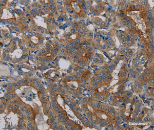 Immunohistochemistry of paraffin-embedded Human thyroid cancer tissue using PER2 Polyclonal Antibody at dilution 1:50