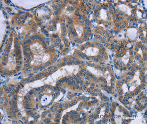 Immunohistochemistry of paraffin-embedded Human thyroid cancer tissue using PLIN1 Polyclonal Antibody at dilution 1:30